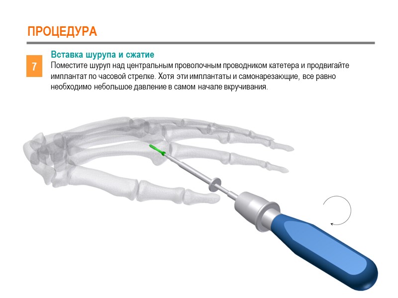 ПРОЦЕДУРА 7 Вставка шурупа и сжатие Поместите шуруп над центральным проволочным проводником катетера и